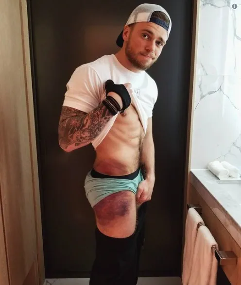 Gus Kenworthy besa a su novio y muestra su cuerpo herido